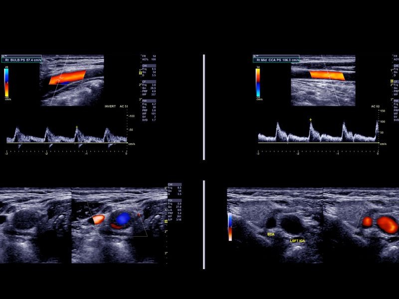 Ultrassom Bolsa Escrotal com Doppler