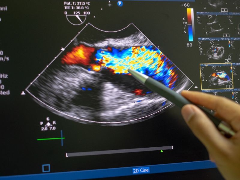 Ultrassom Aorta Abdominal com Doppler